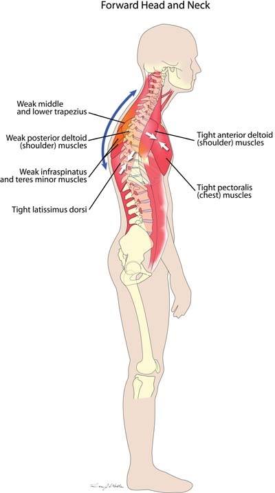 Нахил голови та плечей вперед Нахил голови та плечей вперед