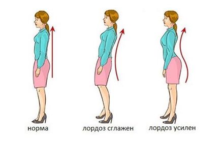 Викривлення хребта (кіфоз, лордоз, сколіоз)